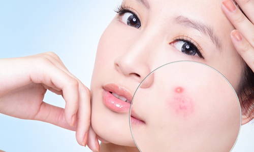 CHĂM SÓC DA SAU MỤN – PHỤC HỒI LÀN DA, LẤY LẠI VẺ MỊN MÀNG TỰ TIN